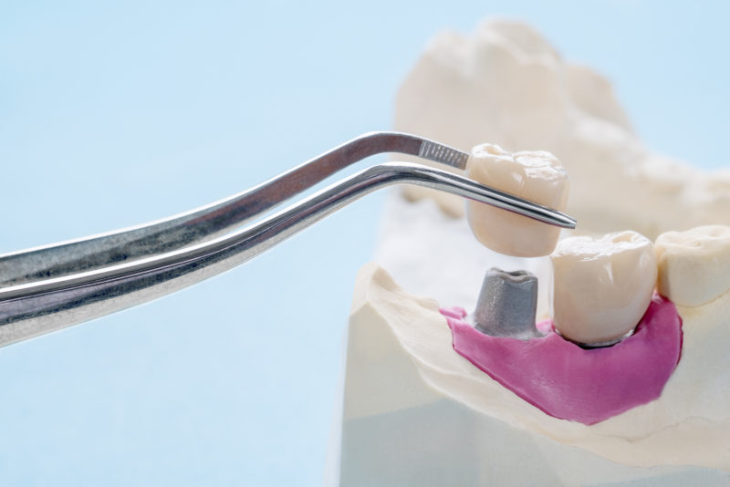 Are Dental Crowns Bad for Your Teeth?