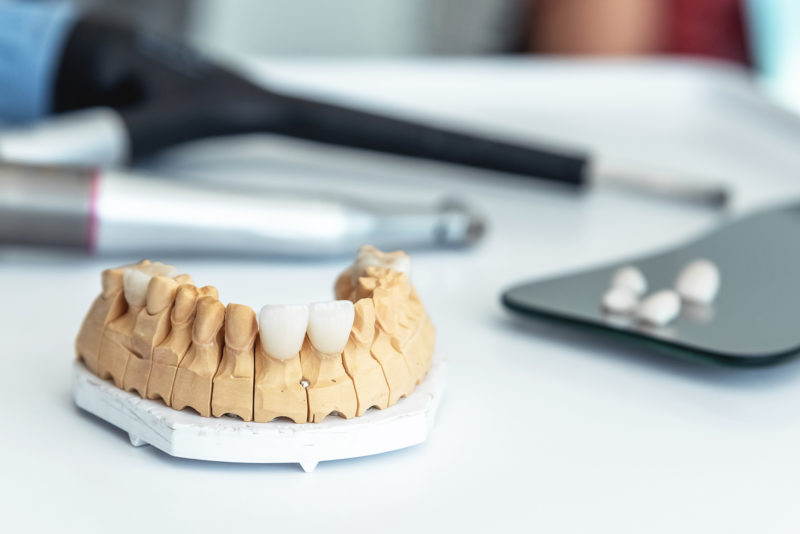 Can Veneers Damage Your Real Teeth?