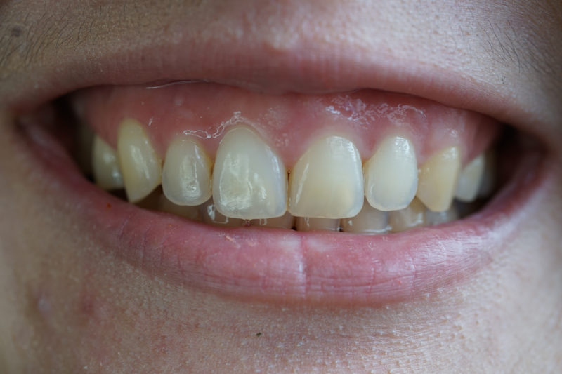 What You Can Do about a “Gummy Smile”