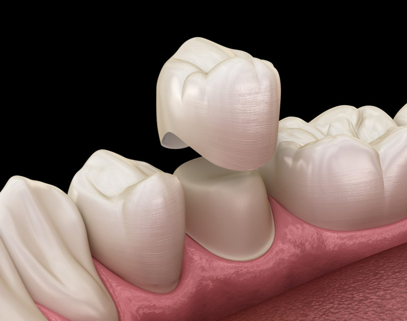 Veneers vs Crowns – What’s the Best Option to Restore my Smile?
