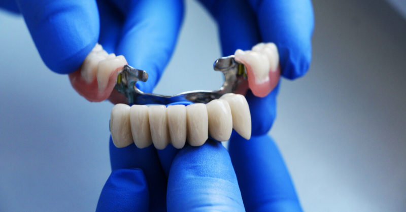 What is a Dental Bridge and How Does it Work?